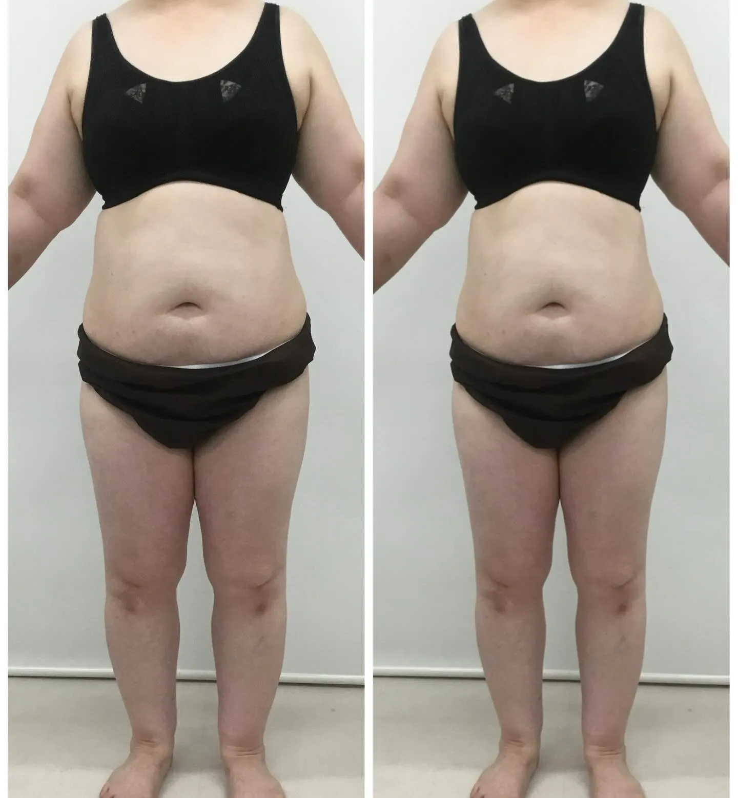 ✨痩身をやって5ヶ月後の自分にびっくり！✨努力のダイエットの...