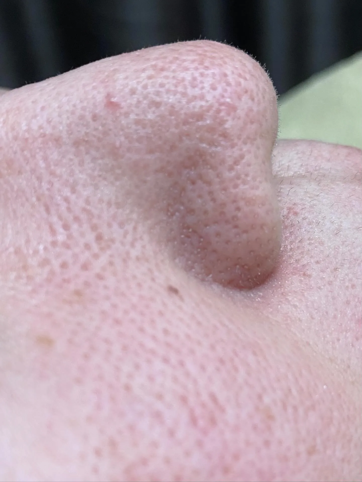 毛穴詰まりのお悩みでお困りですか？😣✨「毛穴の詰まり」や「肌...