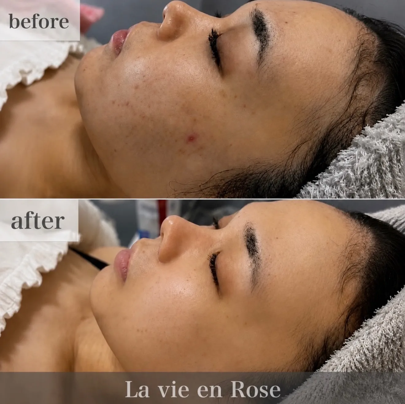 ╲剥離なしのbefore&after╱